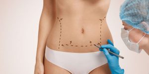 abdominoplasty-tummy-tuck-surgery-singapore