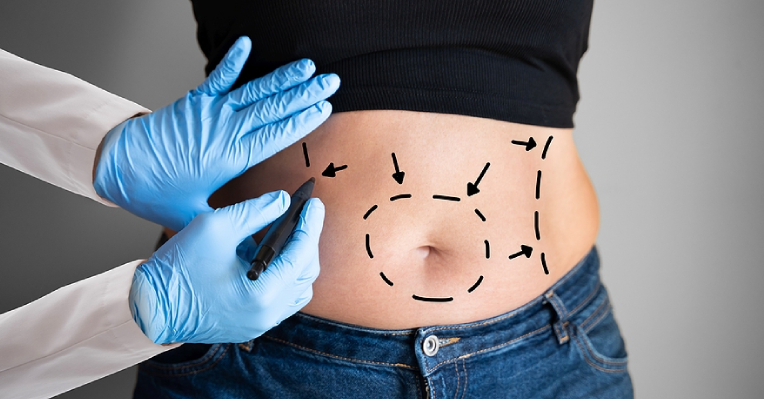 3 Surprising Medical Benefits Of Tummy Tuck Surgery