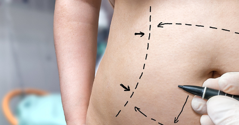 Debunking 4 Common Myths About Tummy Tuck Surgeries
