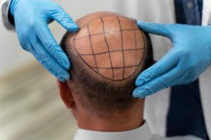 FUE Hair Transplant: What to Expect