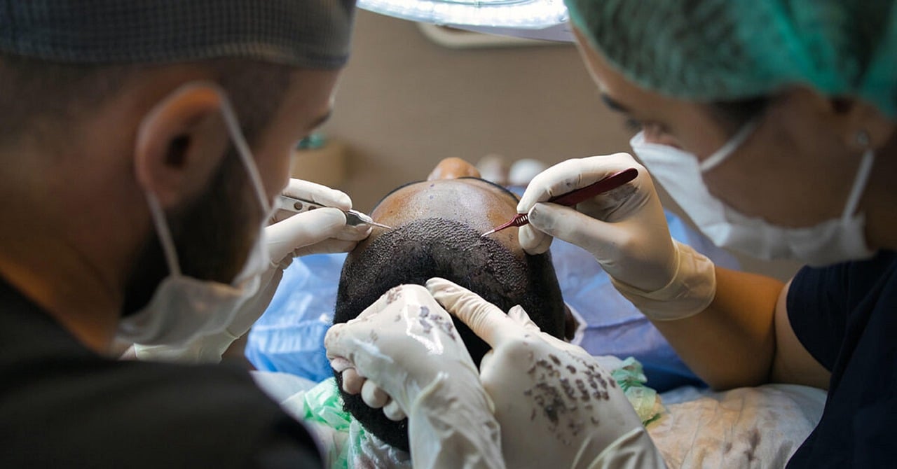 FUE Hair Transplant: What to Expect?